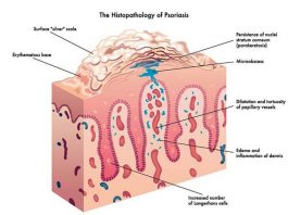 Histopathology of Psoriasis