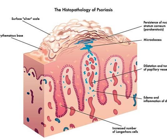 Histopathology of Psoriasis