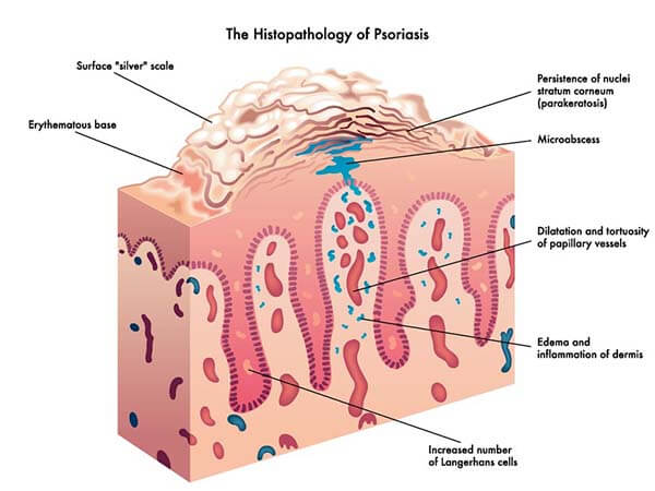 Psoriasis histopathology