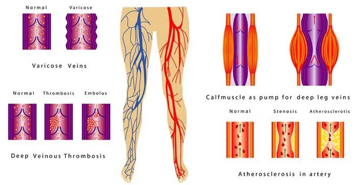 Varicose veins chart
