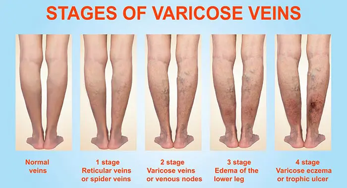 Varicose Veins Explained, Causes and Treatments | SearchGo