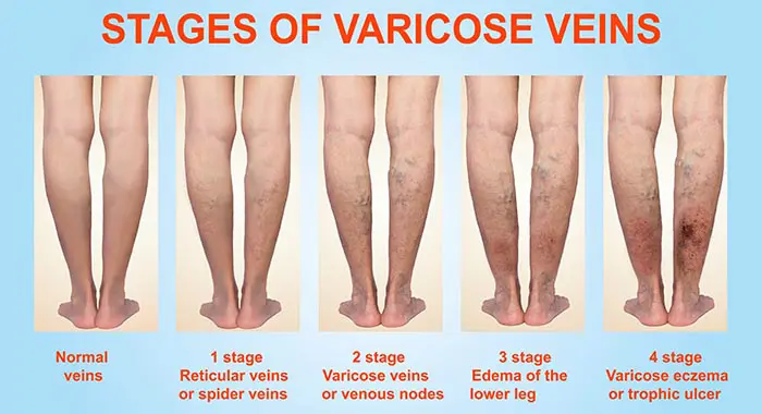 Stages of varicose veins